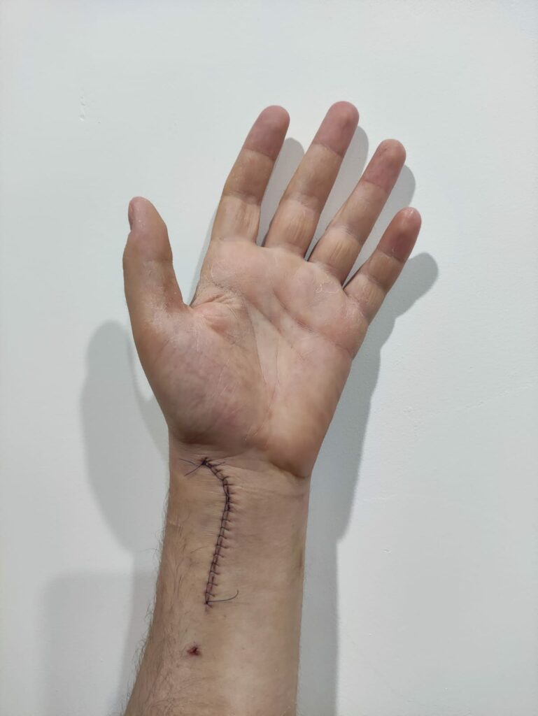 Zdjęcie blizny pooperacyjnej ze szwami po operacji złamania dalszego końca kości promieniowej.