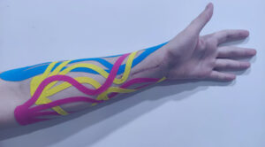 Kinesiology taping ręki lewej- aplikacja drenażowa po zabiegu operacyjnym kończyny górnej lewej.